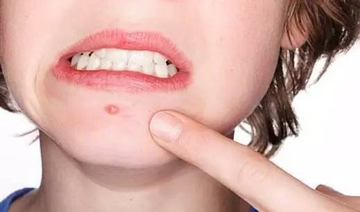 一招快速安全祛痘痘的有效方法,最全的治痘方法