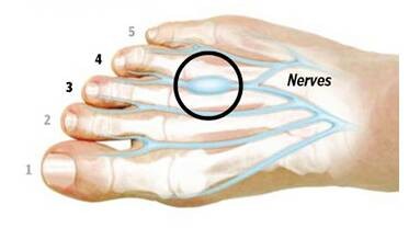 跟腱炎和足底筋膜炎疼痛的区别,足跟痛足底筋膜炎是怎么回事