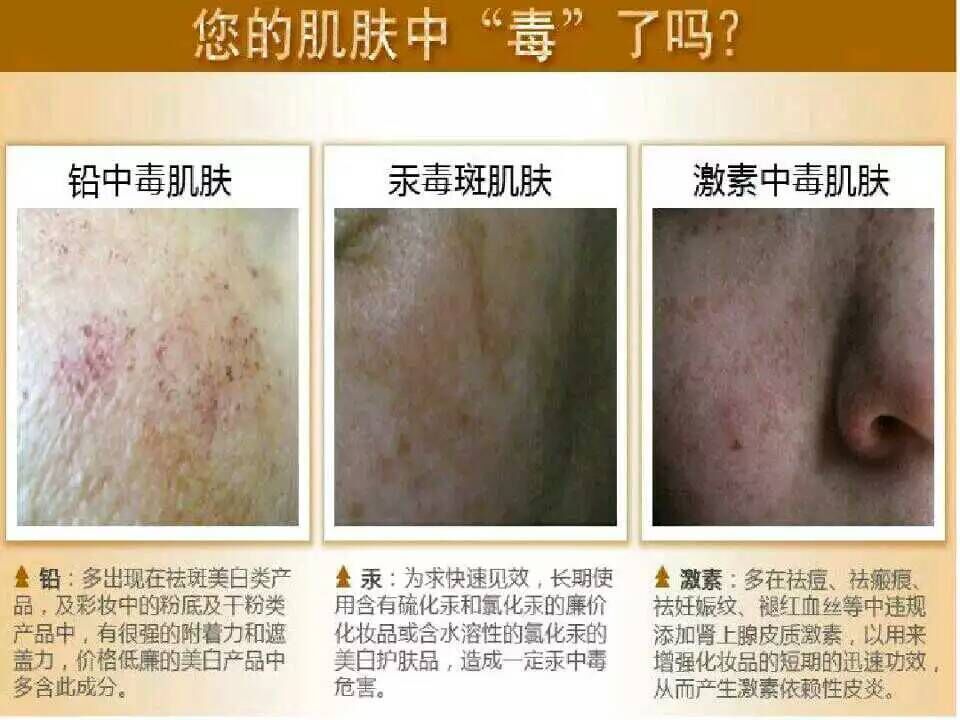 皮肤老是反复过敏是肝脏不好吗,激素依赖皮炎过敏怎样修复