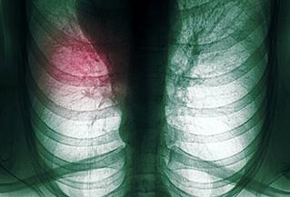 中央型肺癌骨转移,周围型肺癌骨转移