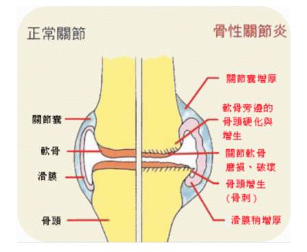 风湿性关节炎夏天如何治疗,怎么去治愈关节炎