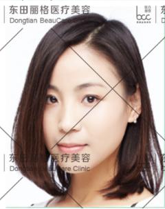 关于瘦脸针的几个常识问题,解密瘦脸针的几大常识性问题