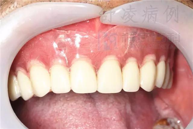 活动假牙戴不住，种植牙又嫌贵该怎么办？