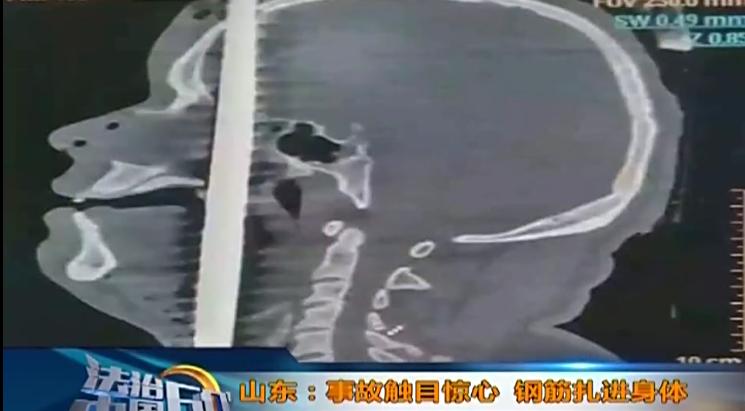 事故触目惊心钢筋扎进身体