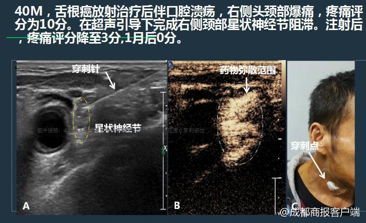 治疗病人的催眠方法,如何发挥自我催眠潜能治疗癌症