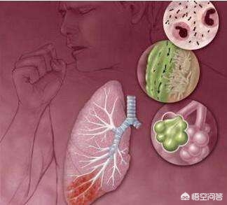 间质性肺炎病因是不是很难找,间质性肺炎的严重程度判断依据