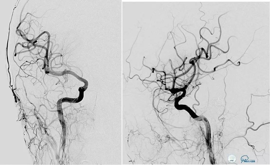 球囊辅助Onyx栓塞治疗硬脑膜动静脉瘘（DAVF）