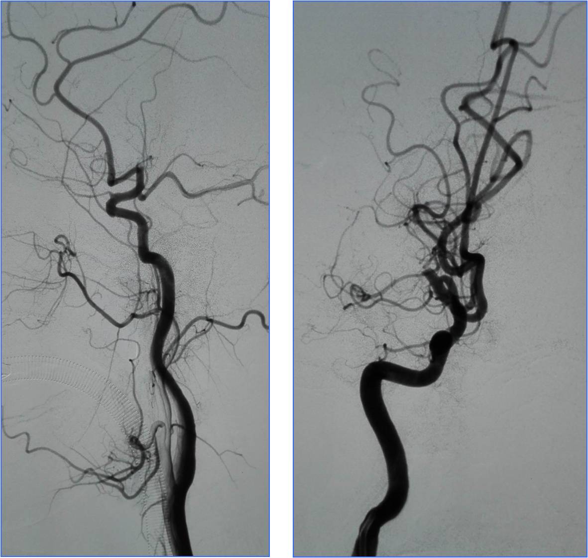 缺血性脑卒中术后管理,急性缺血性脑卒中血管内治疗
