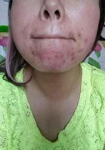 长痘最好的办法就是不要碰它,各种痘对应解决方法