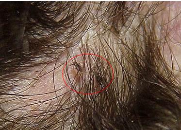 4岁女童头老是痒,4岁女童老是头痒