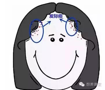 脸再美妆再浓，一颗痘痘毁你容！