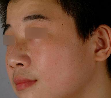 男性斑点怎么内调,男性褐斑怎么治