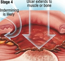 褥疮的护理和治疗方法,褥疮最怕的克星