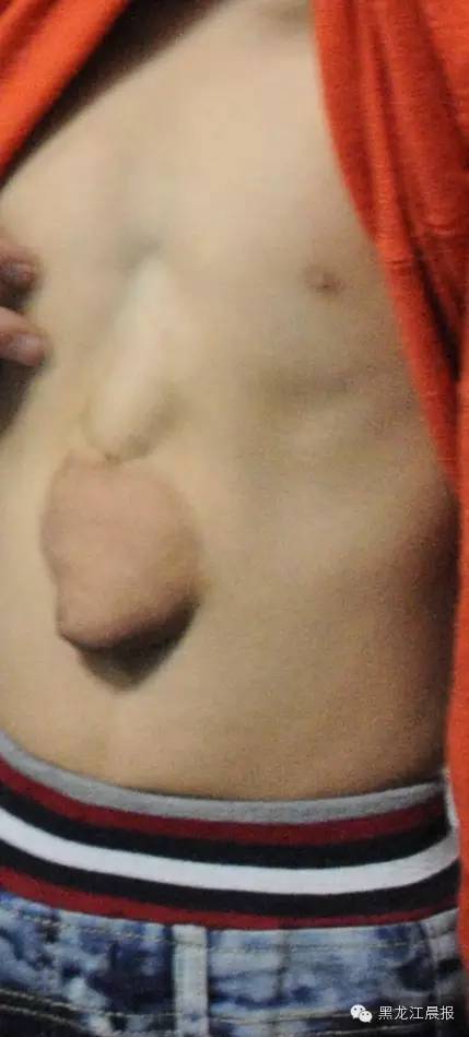 心脏长在肚子里的小女孩做手术,女孩心脏长在肚子上怎么办