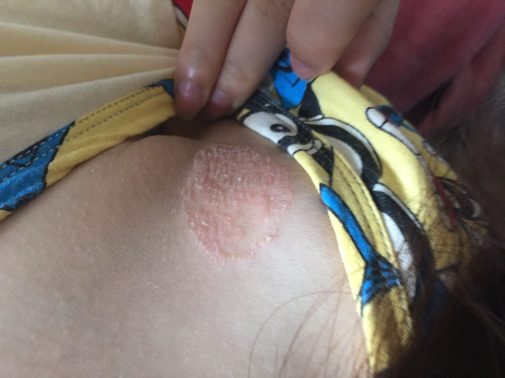 揭秘脚气患者的认识误区,足癣的误区