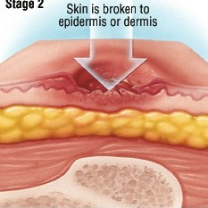 褥疮的护理和治疗方法,褥疮最怕的克星