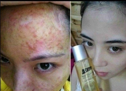 青春痘祛痘痕有效的方法,祛痘痕有效的方法有哪些