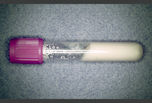 痛风的原因症状和治疗方法,痛风的原因症状