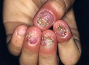 得了灰指甲？你还在自行用药吗？这些治疗误区，看看你有没有！