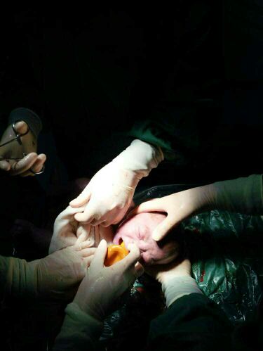 顺产和剖腹产要挨一刀吗,剖腹产可以横一刀竖一刀吗