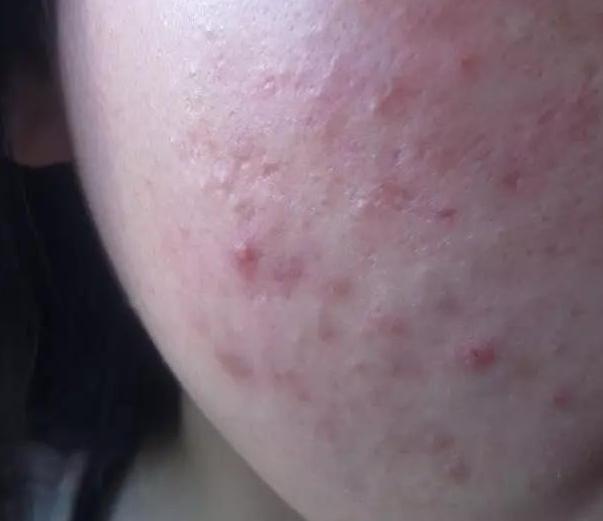 痘痘的分类及形成原因,痘痘的分类和形成原因图片