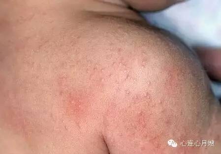 痱子跟湿疹能不能靠肉眼辨认出来,湿疹痱子傻傻分不清文章