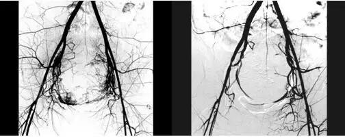 绝经后异常子宫出血诊治指南,中年妇女子宫异常出血要怎么治疗