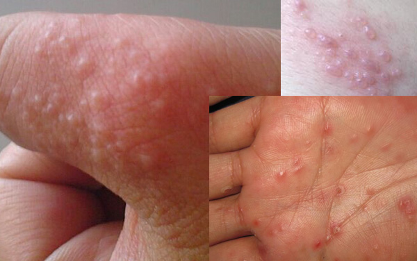 夏天手上长小水泡脱皮是什么原因,夏天喝了冰凉饮料手上就起小水泡