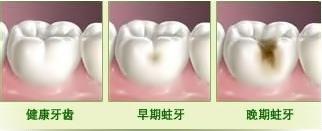 蛀牙的根管治疗,中医治疗蛀牙