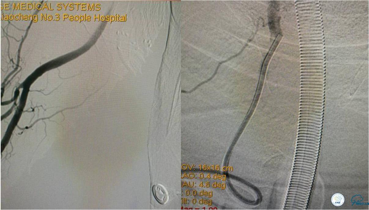 冠状动脉慢性闭塞的介入治疗,颅外段锥动脉狭窄的介入治疗