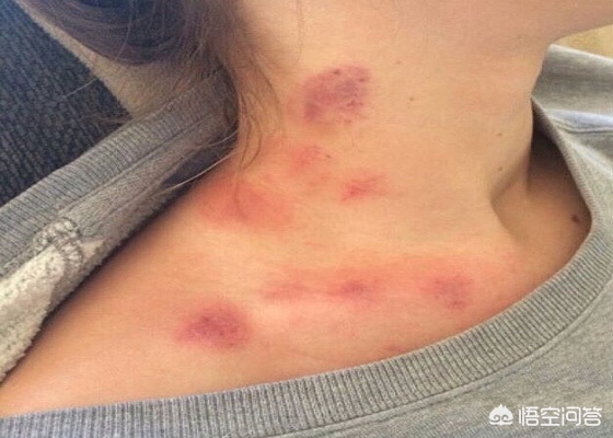 癌症患者可以拔罐放血吗,中医拔罐能治疗癌症吗