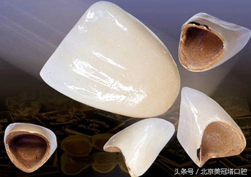 到底应不应该做烤瓷牙,来自医生的忠告不要随便做烤瓷牙