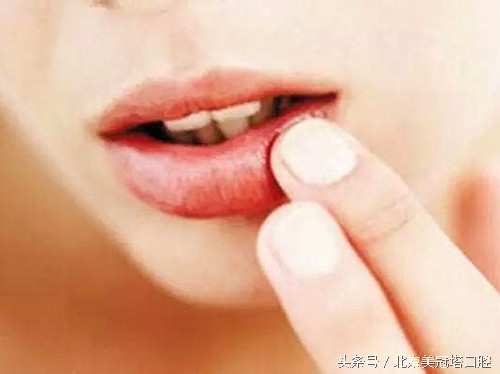 碘酊对口腔粘膜的危害,牙周炎会导致口腔粘膜病变吗