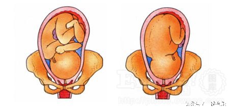 给你全面了解胎位知识，帮助选择分娩方式（上篇）