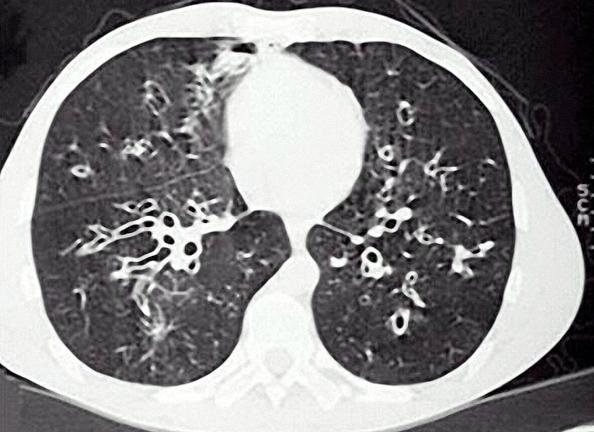支气管扩张最有诊断价值的检查是,什么是支气管扩张和哮喘