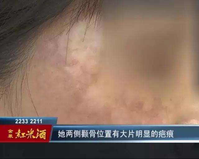 药水祛斑会癌变吗,药水祛斑的危害与效果