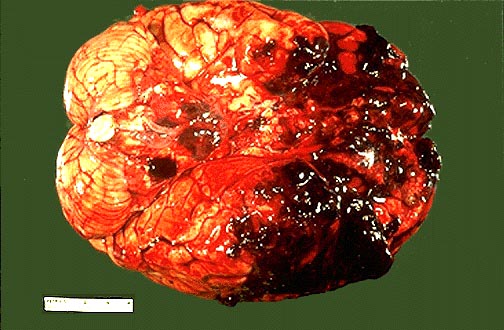 为什么后脑勺摔伤千万要小心—看看这里就知道了