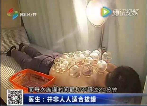 拔火罐火到国外,拔火罐风靡世界