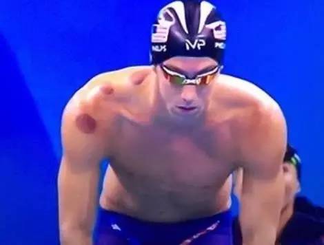 拔火罐有真空原理吗,拔火罐的来源