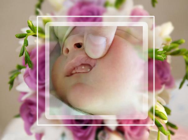 新生婴儿鹅口疮怎么回事,新生儿鹅口疮和正常对比