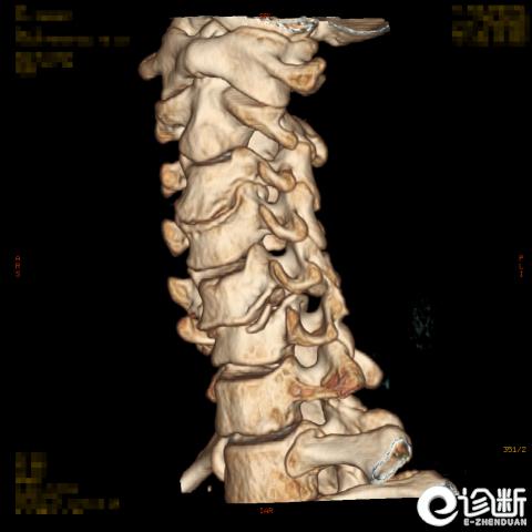 颈椎第五节骨折治疗成功的案例,颈椎骨折的诊断分析