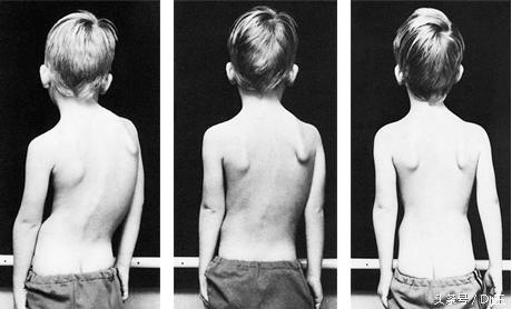 脊柱侧弯治疗费用,脊柱侧弯的几大治疗流派