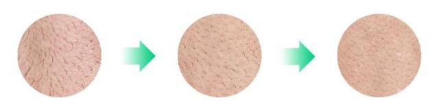 如何选择家用脱毛仪,适合嫩肤的脱毛仪