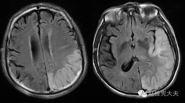 脑卒中简单科普,年轻人是不是不要担心脑卒中