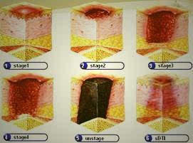 老人长期卧床皮肤有破皮,长期卧床导致皮肤破溃用什么药