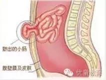 中医治疗小孩疝气验方,小儿疝气最简单的消除方法