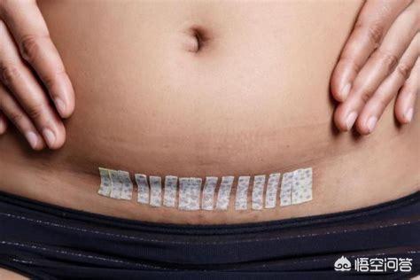 没有指征能剖腹产吗,没有指征可以剖腹产吗