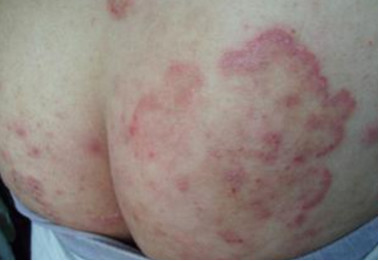 身上有股癣怎么治,身上有股癣怎么去除