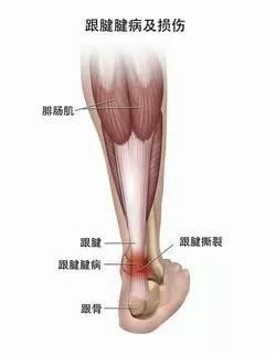 足球运动员跟腱受伤如何治疗,足球运动员跟腱炎一般几天能好