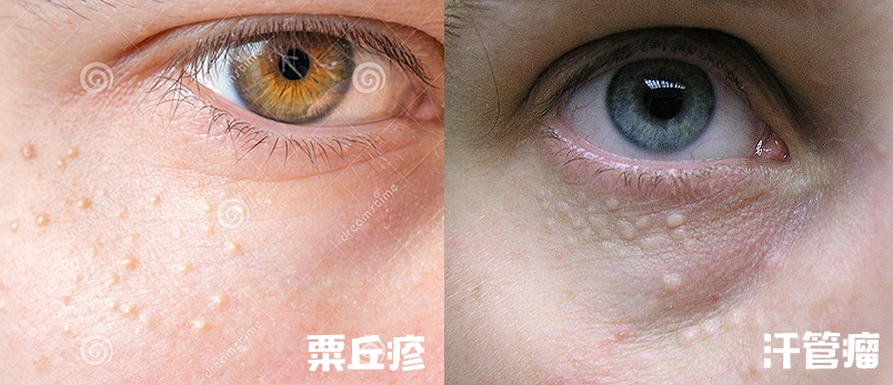 40岁眼周适合用什么样的眼霜,眼周发黑适合用什么眼霜